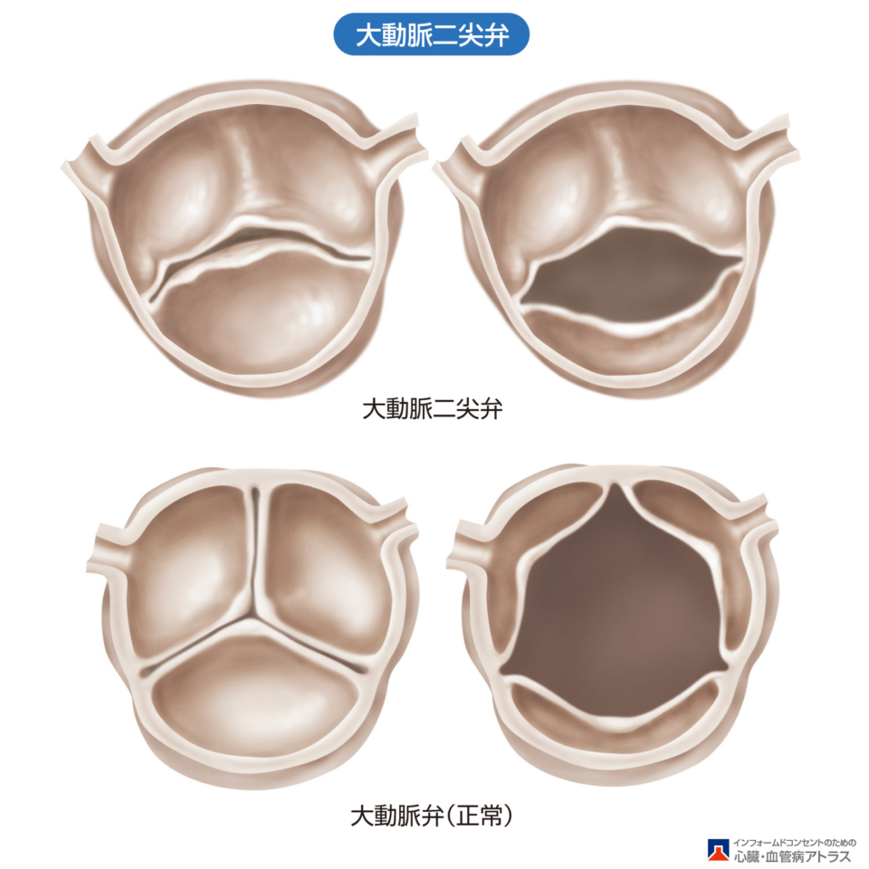 大動脈弁狭窄症に対する人工弁置換術 DVD より大きな人工弁を植込むための工夫 その他